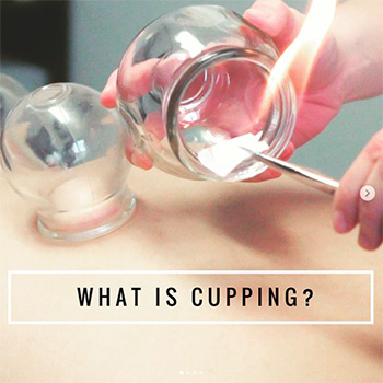 This is an image of Dr. Khanita doing Chinese fire cupping therapy on someone’s back (close-up view), a form of Traditional Chinese Medicine that uses a flame to create suction within the cups. The text says “What is Cupping?”
