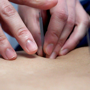 This is a very close up image of Dr. Khanita placing acupuncture needles on a client's back.